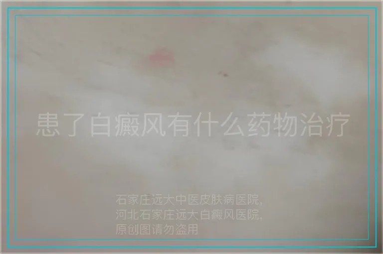 患了白癜风有什么药物治疗