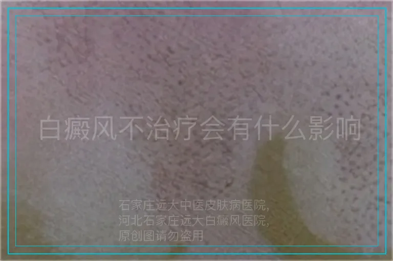 白癜风不治疗会有什么影响