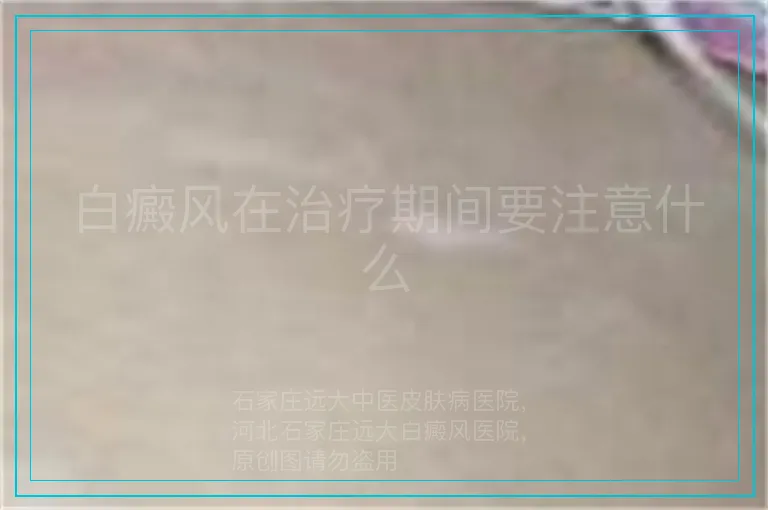 白癜风在治疗期间要注意什么