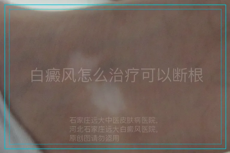 白癜风怎么治疗可以断根
