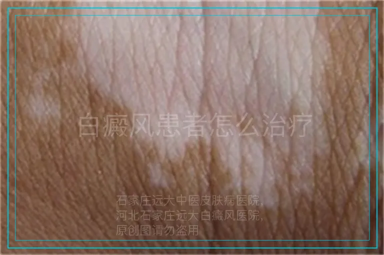 白癜风患者怎么治疗
