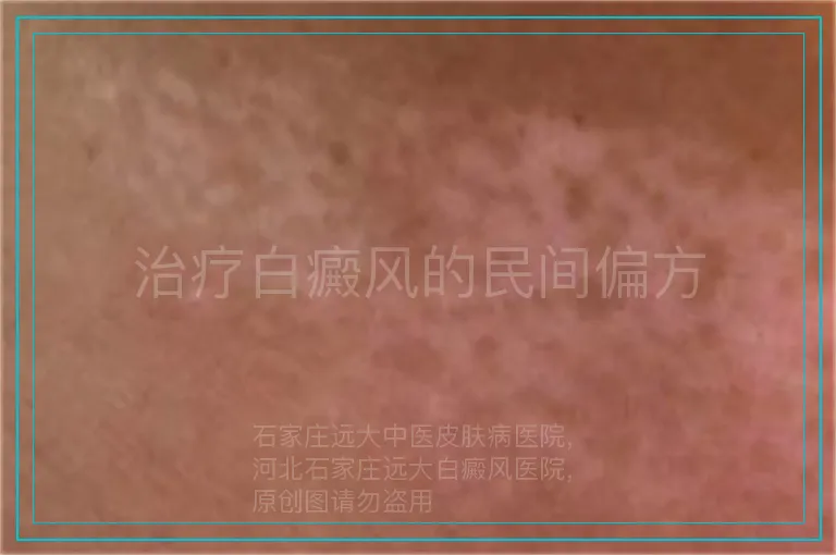 治疗白癜风的民间偏方