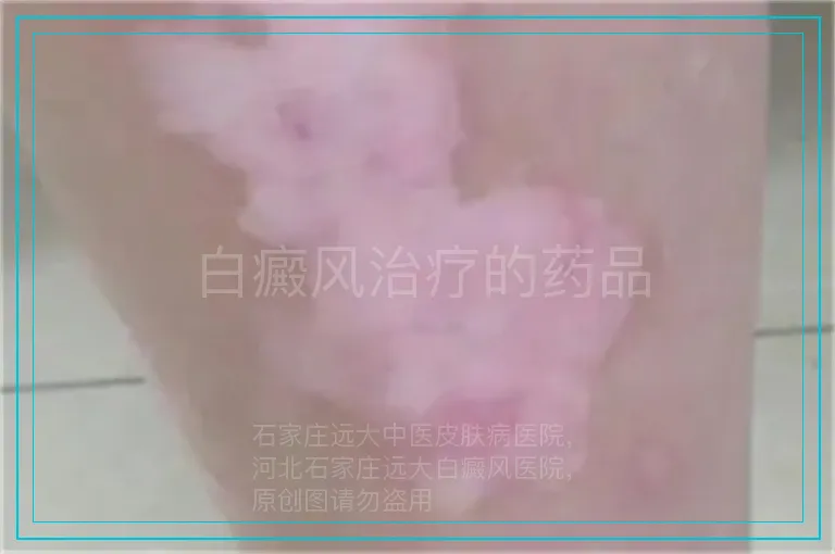 白癜风治疗的药品