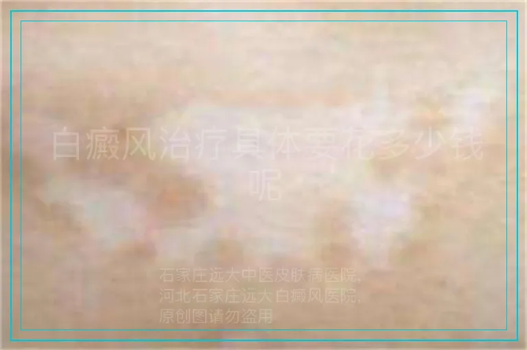 白癜风治疗具体要花多少钱呢