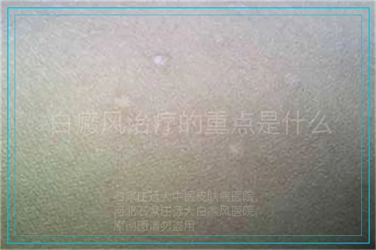 白癜风治疗的重点是什么