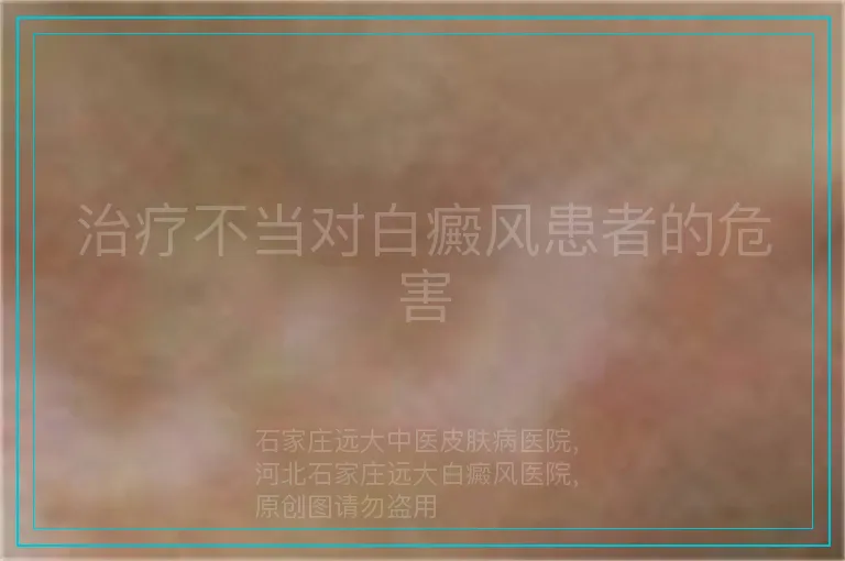 治疗不当对白癜风患者的危害