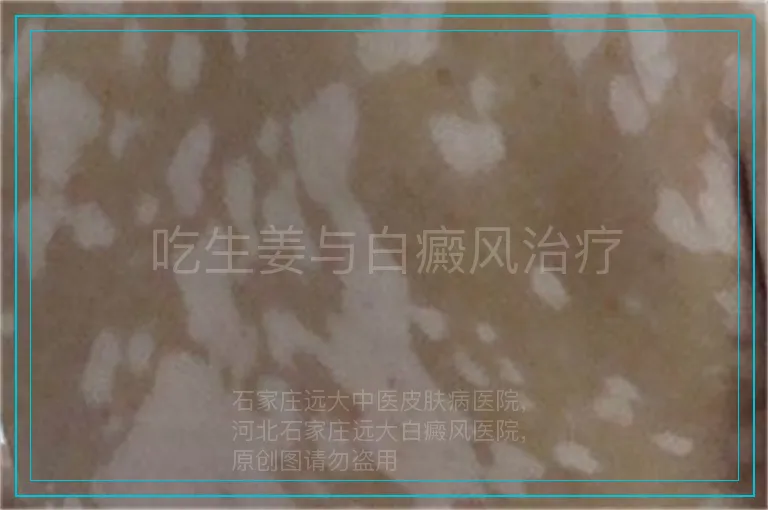 吃生姜与白癜风治疗