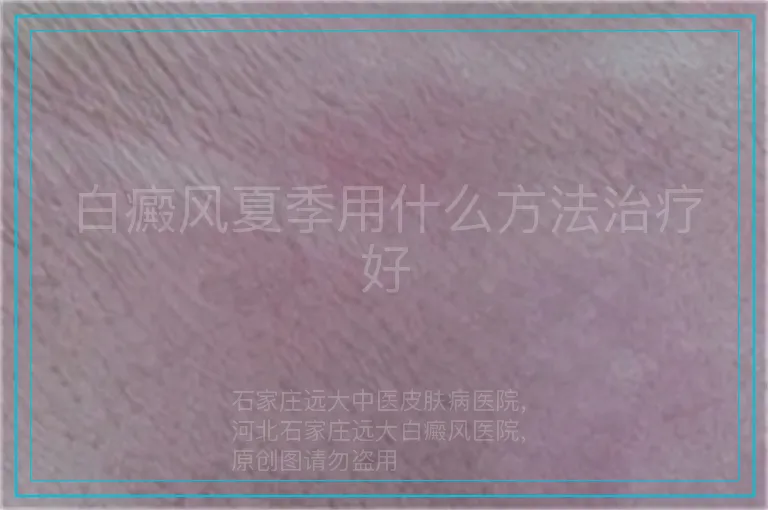 白癜风夏季用什么方法治疗好