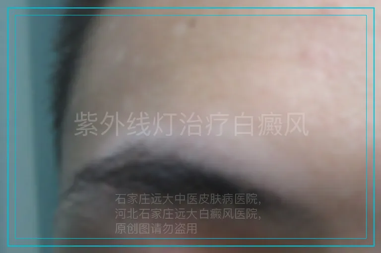 紫外线灯治疗白癜风