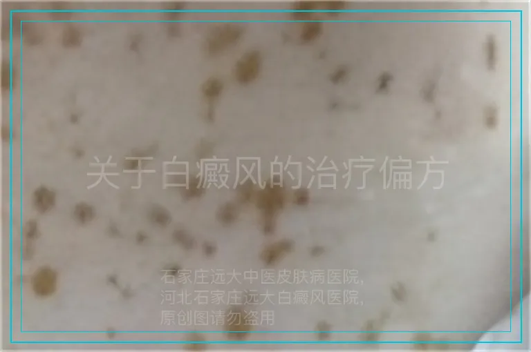 关于白癜风的治疗偏方