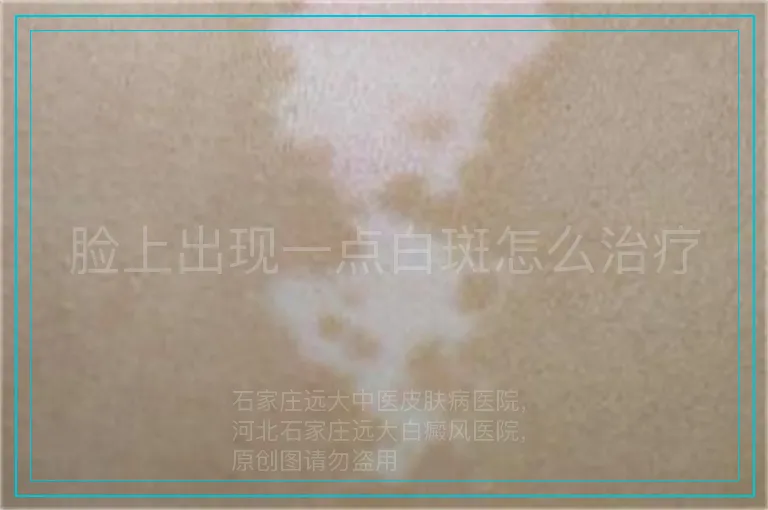 脸上出现一点白斑怎么治疗