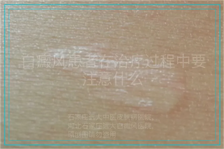白癜风患者在治疗过程中要注意什么