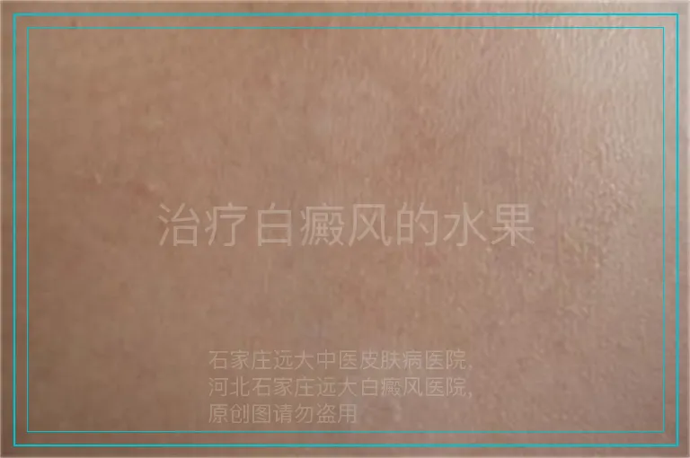 治疗白癜风的水果