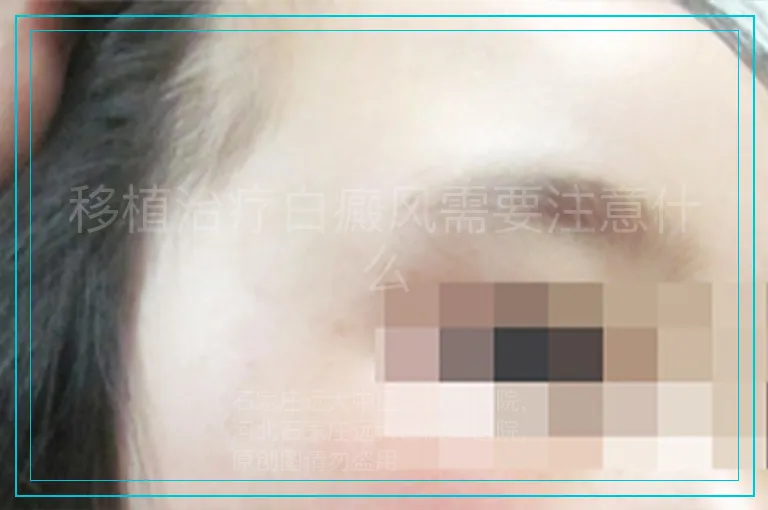 移植治疗白癜风需要注意什么