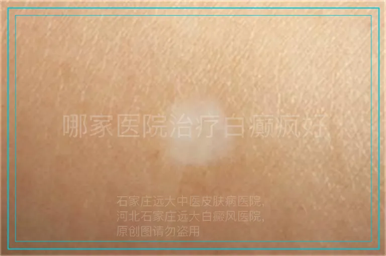 哪家医院治疗白癫疯好