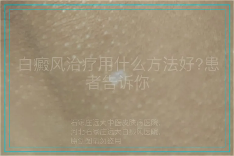 白癜风治疗用什么方法好?患者告诉你