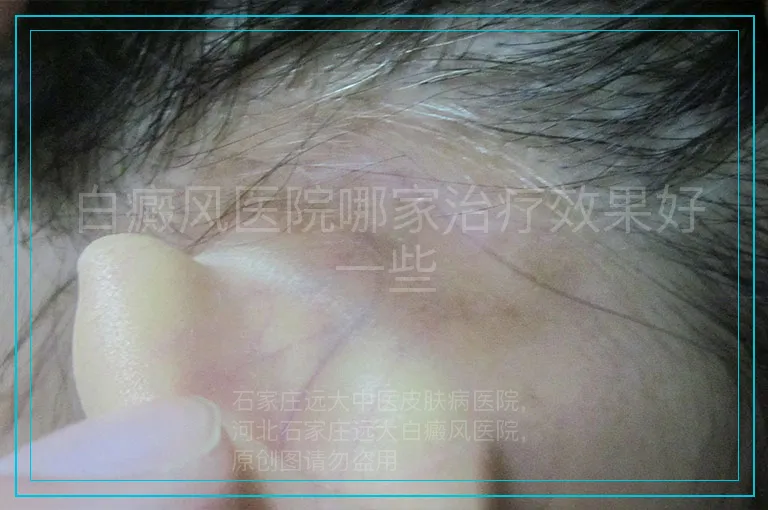 白癜风医院哪家治疗效果好一些
