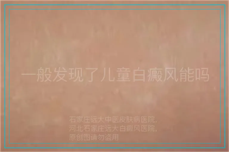 一般发现了儿童白癜风能吗