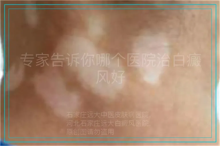 专家告诉你哪个医院治白癜风好
