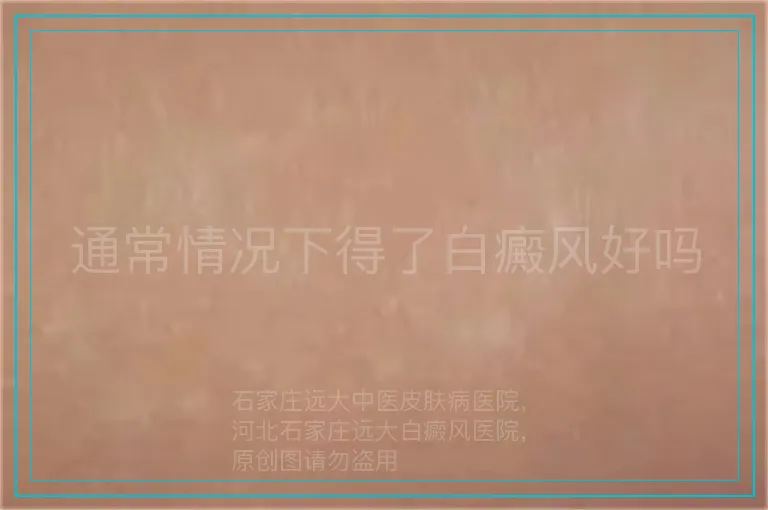 通常情况下得了白癜风好吗