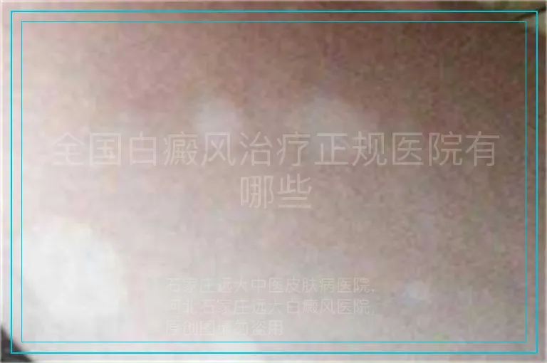 全国白癜风治疗正规医院有哪些