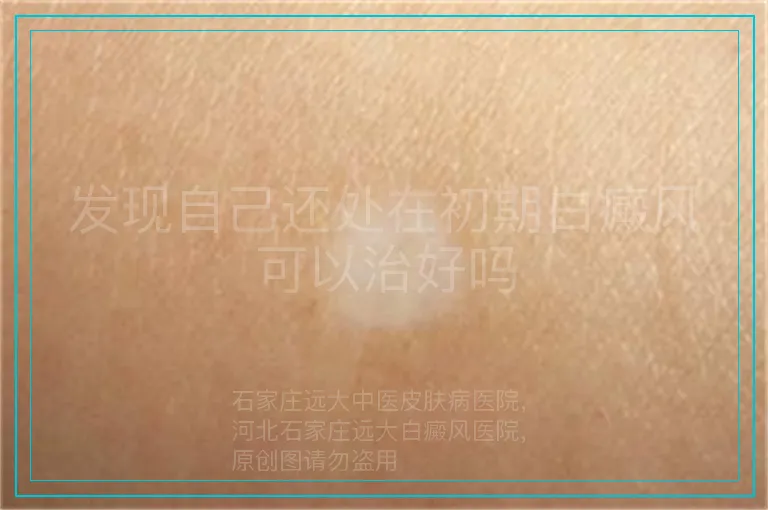 发现自己还处在初期白癜风可以治好吗