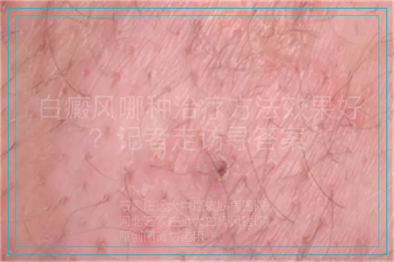 白癜风哪种治疗方法效果好?记者走访寻答案