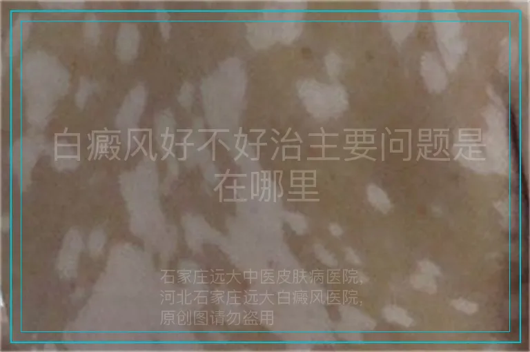 白癜风好不好治主要问题是在哪里
