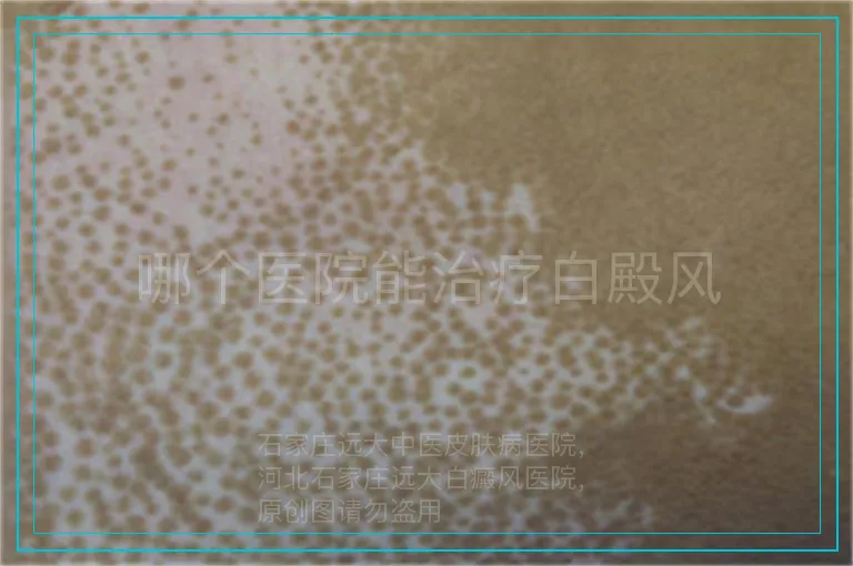 哪个医院能治疗白殿风