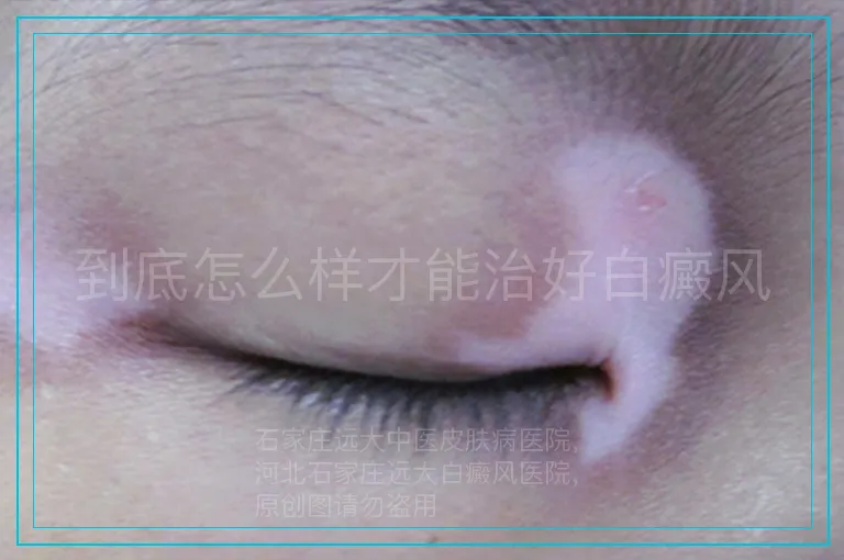 到底怎么样才能治好白癜风