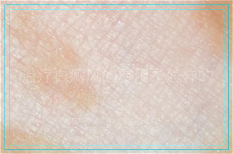 治疗白癜风的费用是怎样的