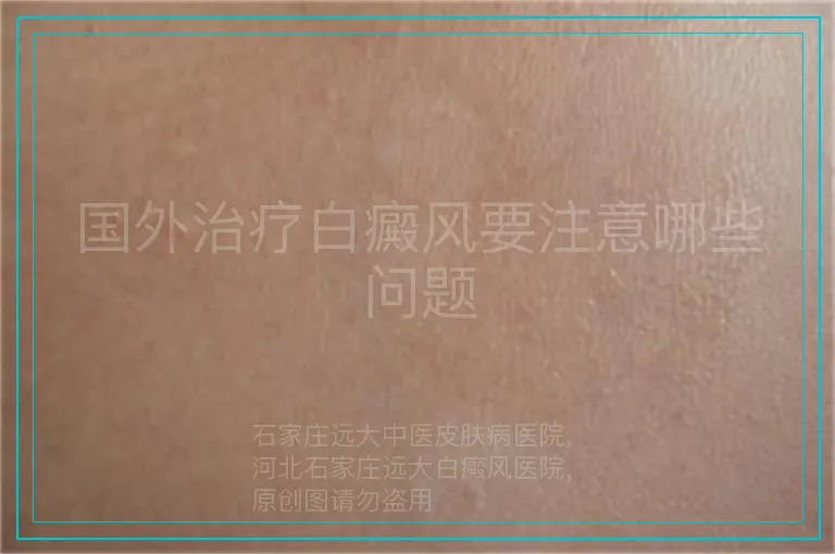 国外治疗白癜风要注意哪些问题