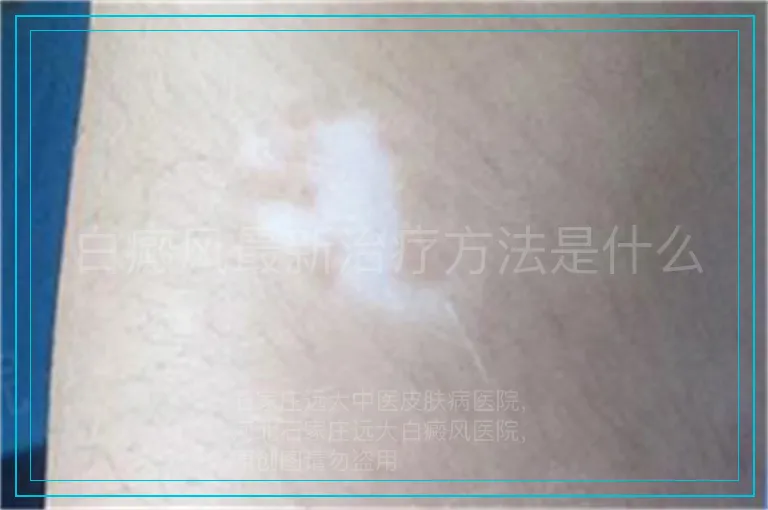 白癜风最新治疗方法是什么