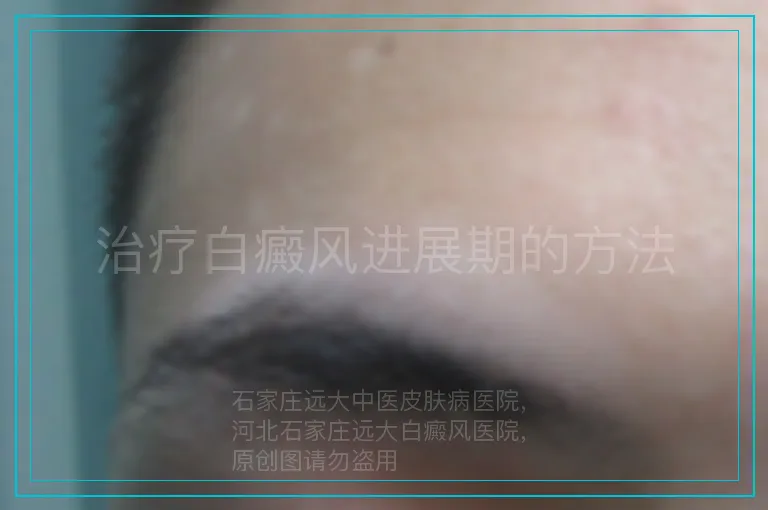 治疗白癜风进展期的方法