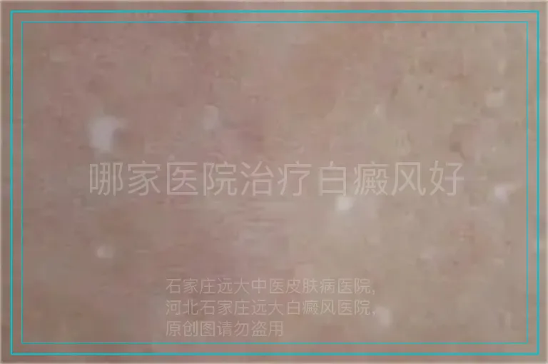 哪家医院治疗白癜风好