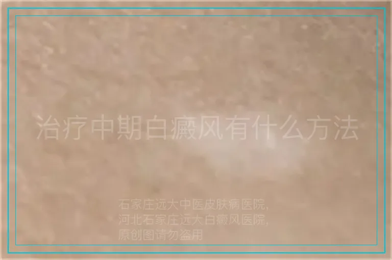 治疗中期白癜风有什么方法