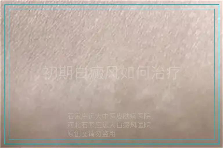 初期白癜风如何治疗