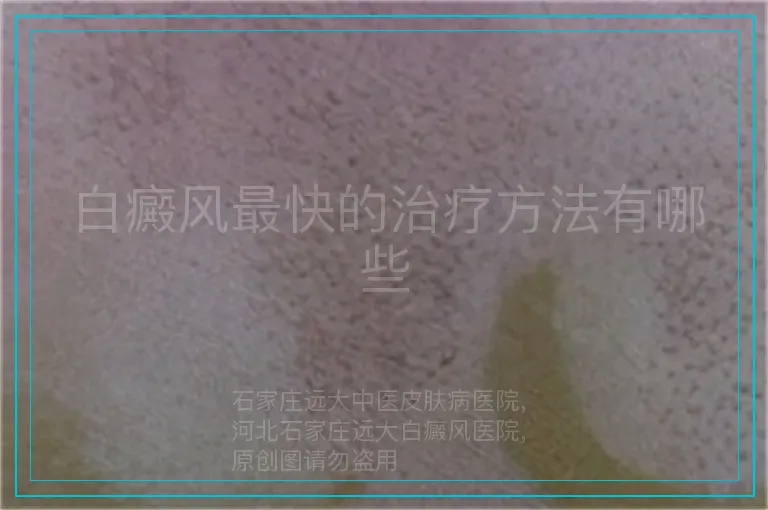 白癜风最快的治疗方法有哪些