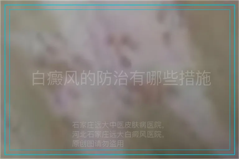 白癜风的防治有哪些措施