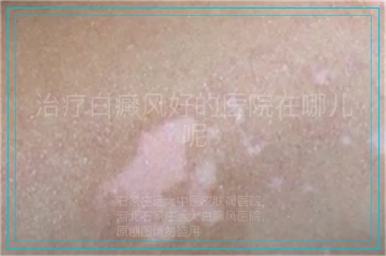 治疗白癜风好的医院在哪儿呢