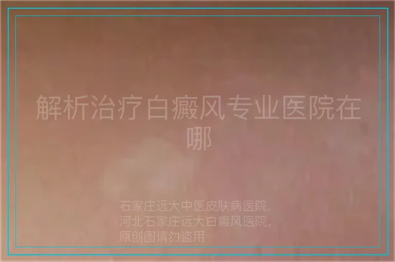 解析治疗白癜风专业医院在哪