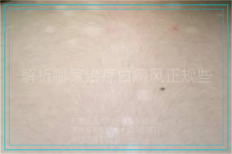 解析哪家治疗白癜风正规些