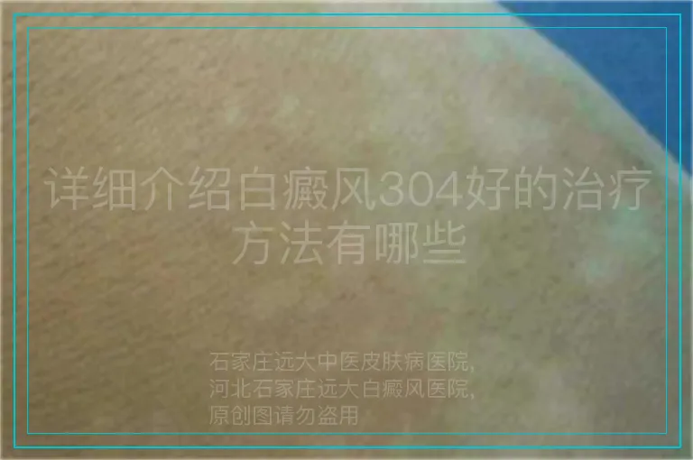 详细介绍白癜风304好的治疗方法有哪些