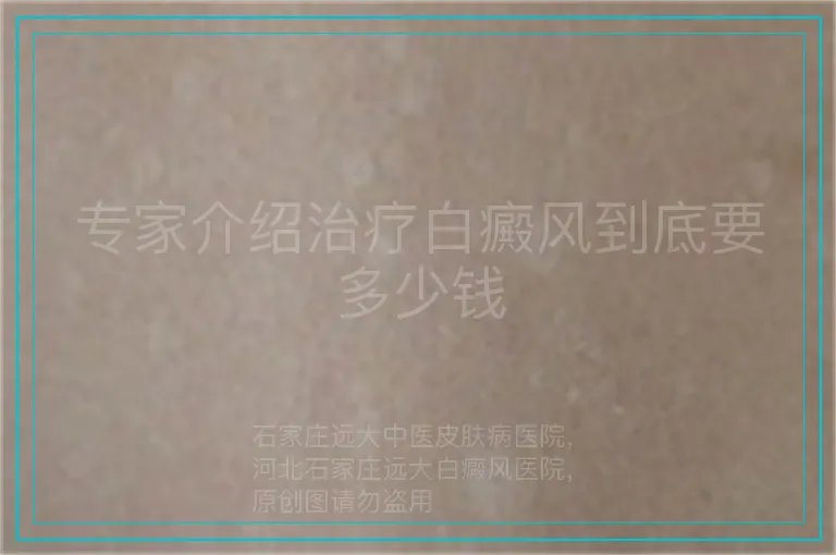 专家介绍治疗白癜风到底要多少钱