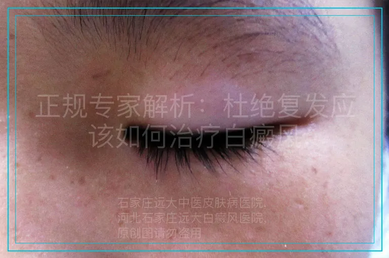 正规专家解析：杜绝复发应该如何治疗白癜风