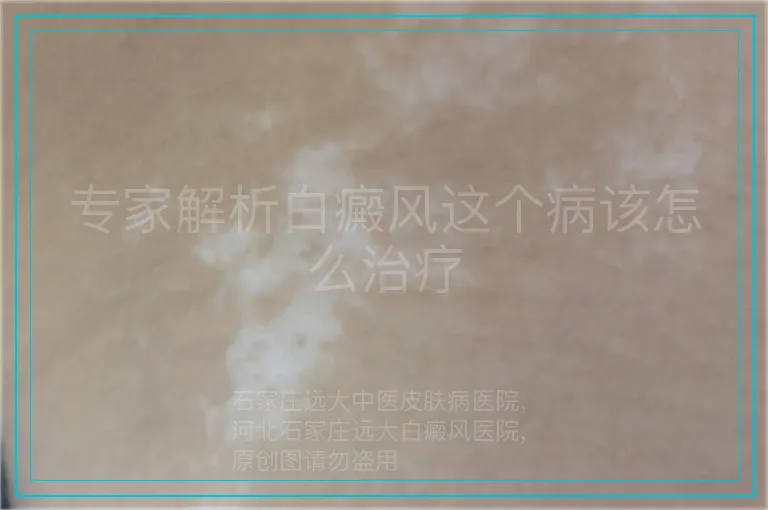 专家解析白癜风这个病该怎么治疗