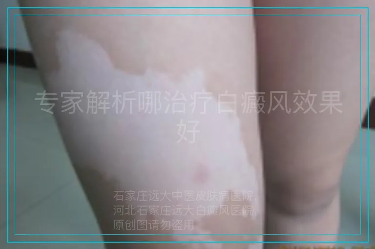 专家解析哪治疗白癜风效果好