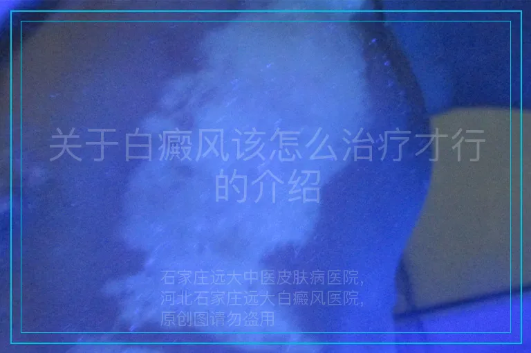 关于白癜风该怎么治疗才行的介绍