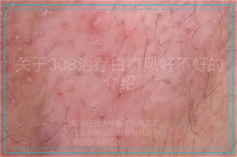 关于308治疗白癜风好不好的介绍