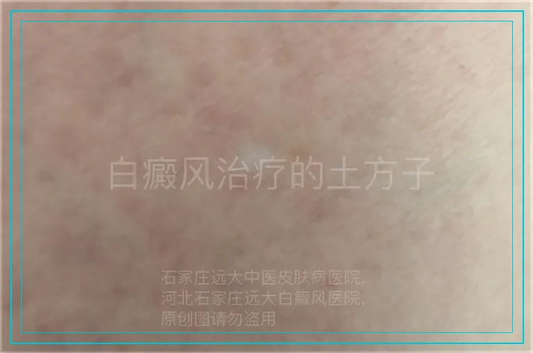 白癜风治疗的土方子